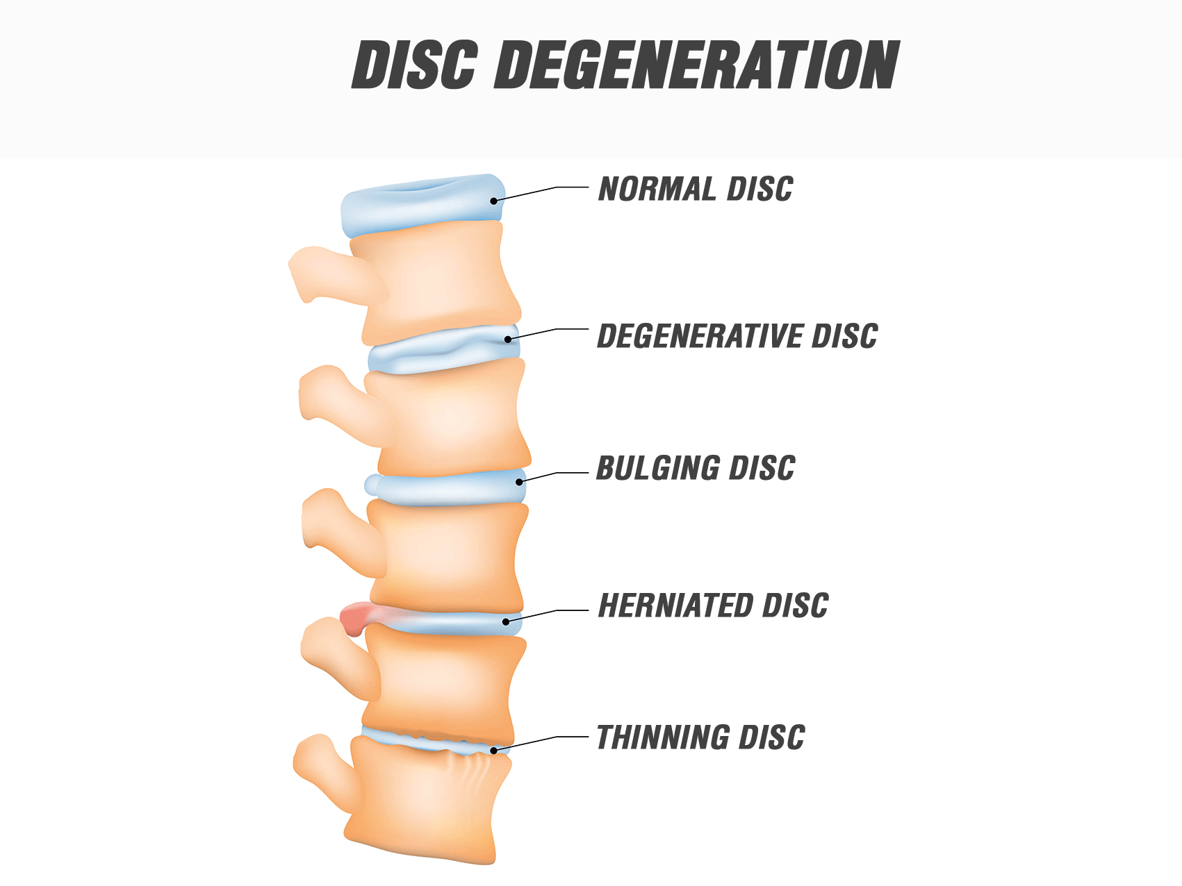 Disc Degeneration