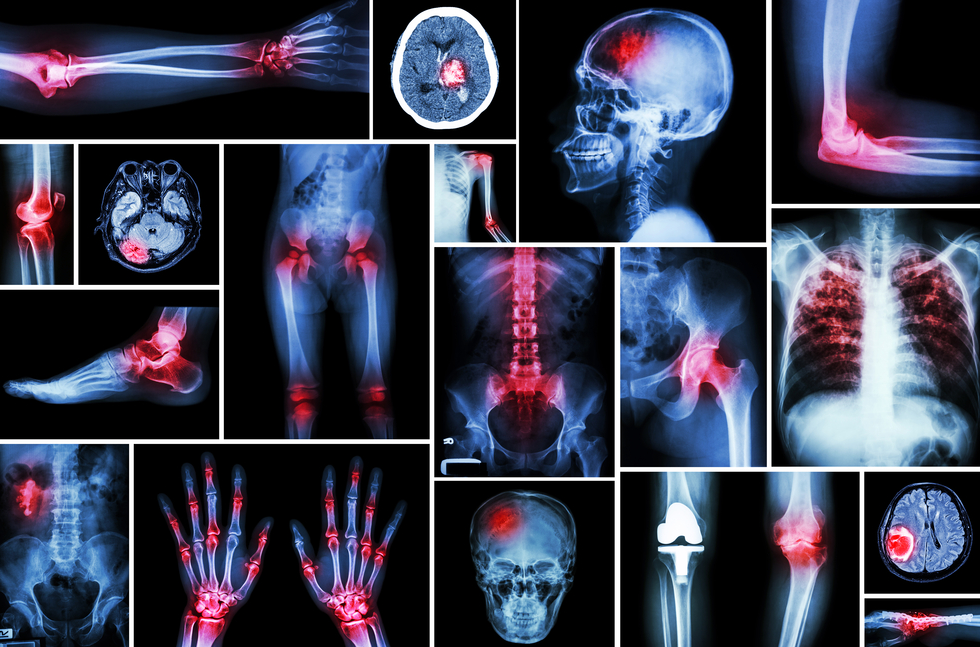 Osteoarthritis Cannabis Relieves Pain 